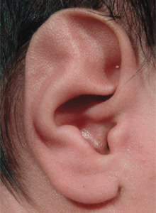 External Ear Malformations
