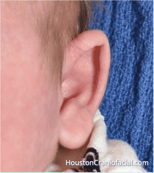 Dumbo Ears in Newborns: 1 Solution Parents Need To Know