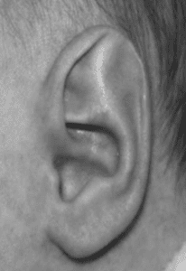 Pointy Ears in Newborns