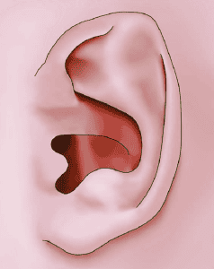 Pointy Ears in Newborns