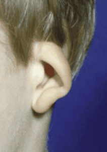 Cup Ear Deformity