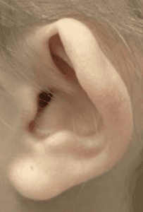 Lop Ear Deformity