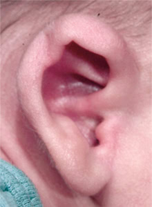 Constricted Ear Deformity