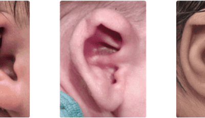 Why Are My Baby’s Ears Folded Over?