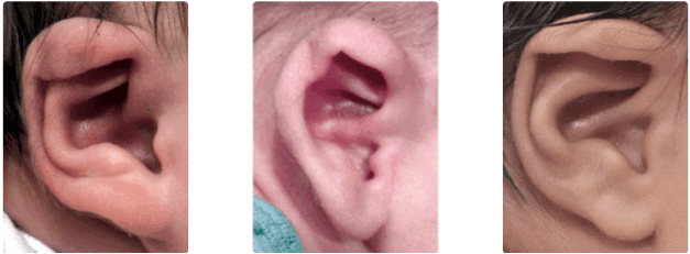 Why Are My Baby’s Ears Folded Over?