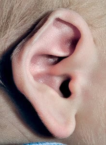 Helical Rim Deformity