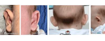 Prominent Ears in Newborns. What Every Parent Should Know