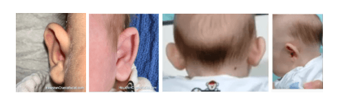 Prominent Ears in Newborns. What Every Parent Should Know