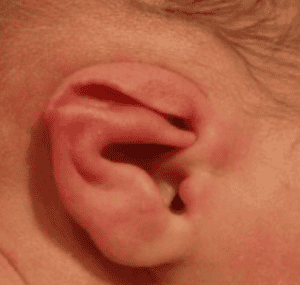 Lidding Ear