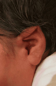 Lidding Ear
