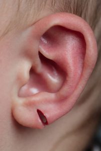 Cleft Ear