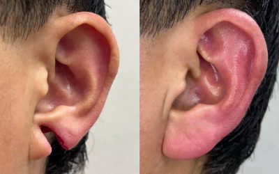 Cleft Ear Deformities in Infants: Understanding Your Treatment Options