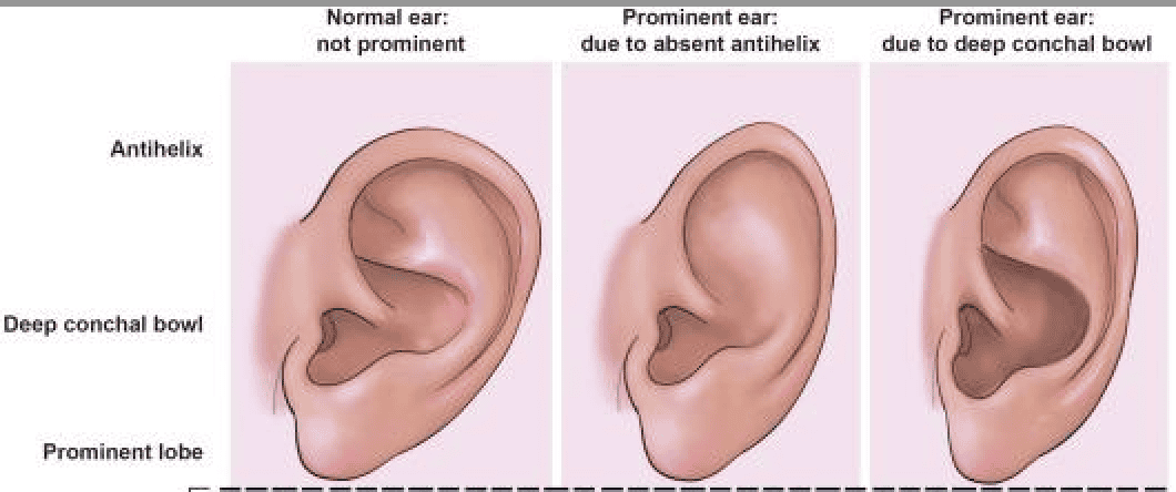 Cross-section diagram showing how a deep conchal bowl pushes the ear away from the head