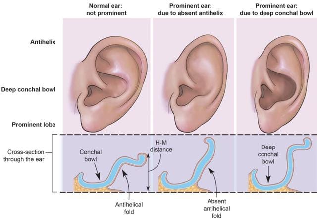 Diagram comparing a normal ear to a prominent ear caused by an absent antihelical fold
